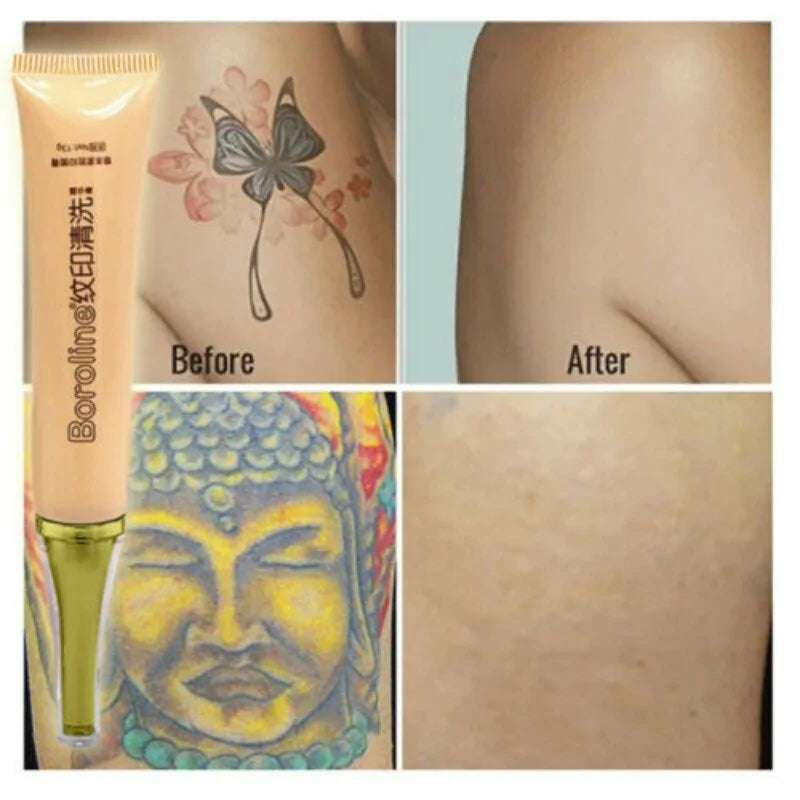 Permanent Tattoo Cream Removal